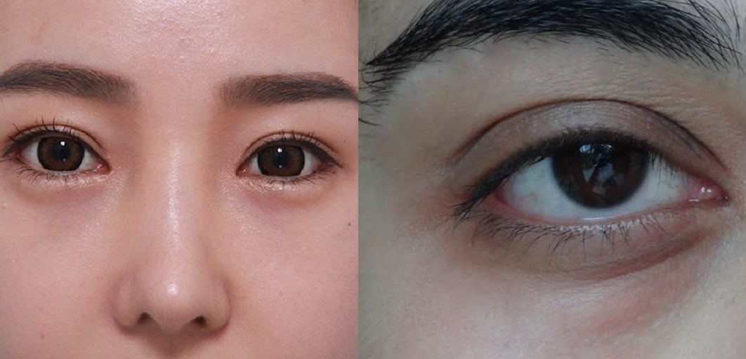 Chỉ bằng một thìa muối, quầng thâm, bọng mắt sẽ tan biến sau 5 phút