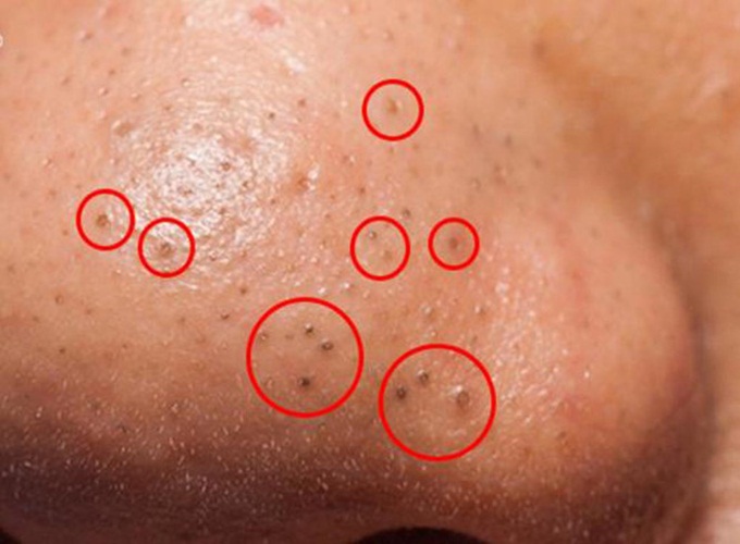 Độc chiêu trị sạch các loại mụn hai bên cánh mũi chỉ bằng chanh và trứng gà