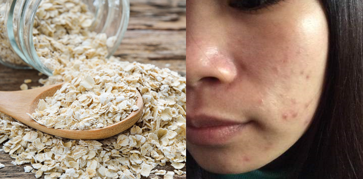 Đây chính là 7 cách trị mụn ẩn bằng yến mạch siêu hiệu quả nhanh như "một cơn gió"