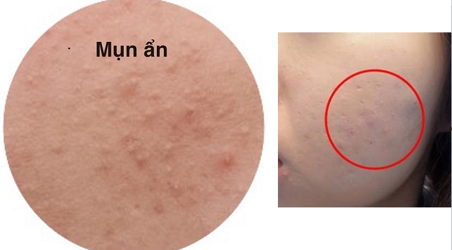 Không chỉ 1 cách trị mụn ẩn hiệu quả nhất mà có tới 6 cách đấy chị em nhé