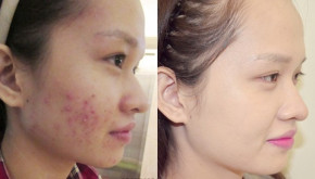 Bí kíp xóa sổ mụn trứng cá chi chít nhờ thuốc nhỏ mắt