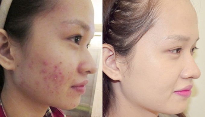 Bí kíp xóa sổ mụn trứng cá chi chít nhờ thuốc nhỏ mắt