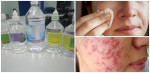 Mụn đầy mặt cũng hết ngay, da sạch trơn láng mịn chỉ với chai nước muối sinh lý 5k bán đầy ngoài tiệm thuốc!