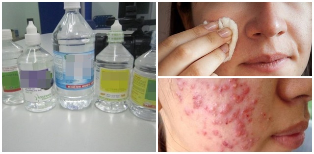 Mụn đầy mặt cũng hết ngay, da sạch trơn láng mịn chỉ với chai nước muối sinh lý 5k bán đầy ngoài tiệm thuốc!
