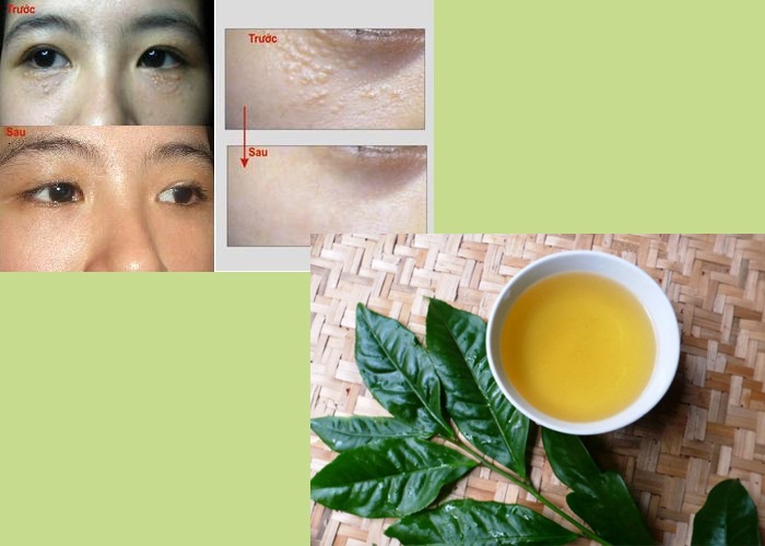 Lạ lùng với mẹo trị mụn thịt dân gian mang lại “phép màu” cho làn da