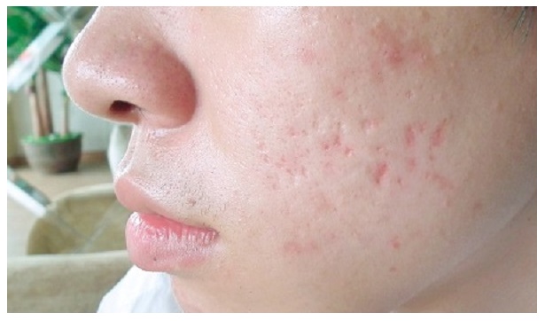 Cứ mụn xong là thâm mụn thâm sẹo đầy mặt, giờ đã có cách trị dứt điểm rồi đấy