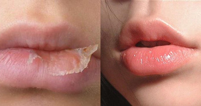 Ba mẹo dưỡng môi căng mọng, hồng hào, không bị nứt nẻ suốt cả mùa lạnh