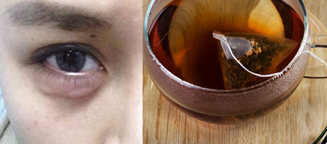 Quầng thâm hay bọng mắt sẽ nhanh chóng mất hết chỉ nhờ 2 nguyên liệu rẻ tiền này