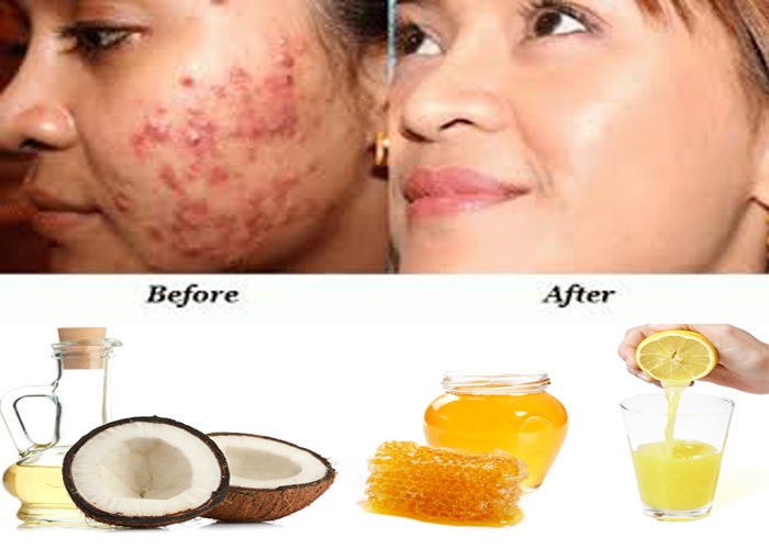 Cách làm xẹp mụn sưng đỏ nhanh tuy “không đắt” nhưng vẫn “xắt ra miếng”