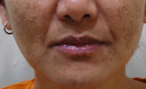 Các loại vitamin giúp chữa trị nám da hiệu quả