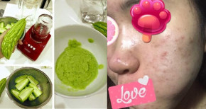Mụn - "kẻ thù truyền kiếp" sẽ bị xóa sạch sau khi thực hiện cách đơn giản này