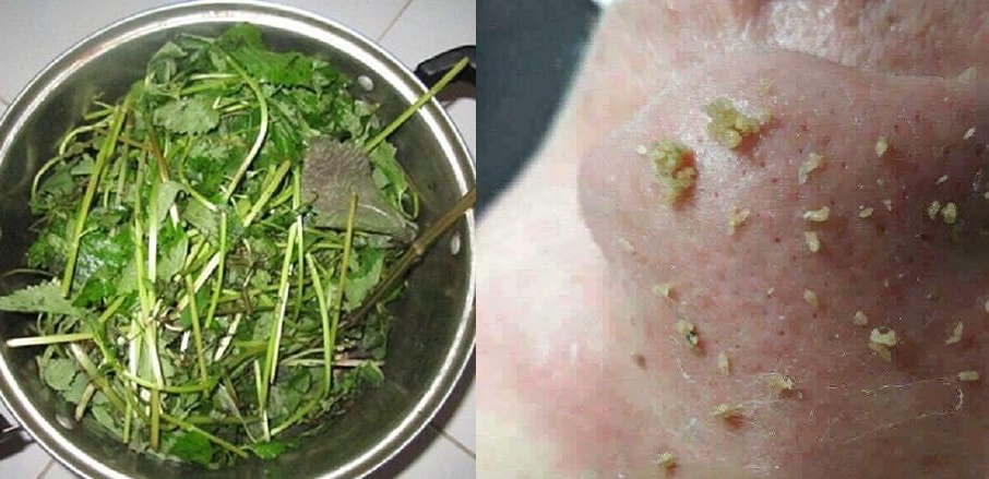 Trước khi đi ngủ chỉ cần xông hơi bằng chậu nước này là nhân mụn đầu đen cứ thế bị đẩy lên SẠCH SÀNH SANH đấy