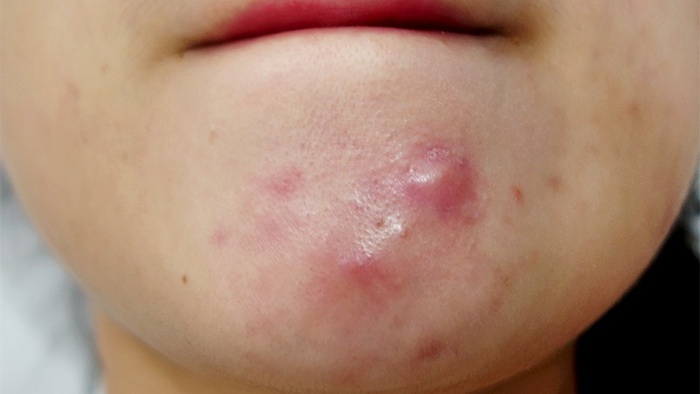 Chỉ 10 ngày đánh bay mụn nội tiết thời kỳ kinh nguyệt nhờ cách hay ai cũng làm được