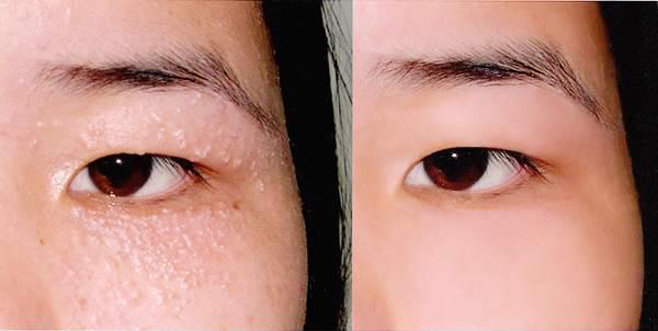 Chỉ 2k có ngay 2 cách trị mụn thịt quanh mắt &rsquo;một đi không trở lại&rsquo;