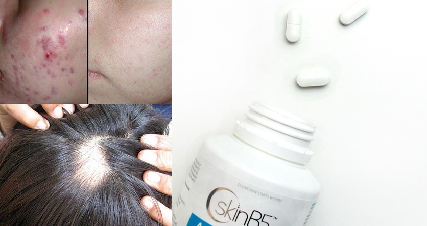 Không phải viên B1 hay E, viên B5 mới là anh hùng cho da mụn và tóc yếu, xơ rối