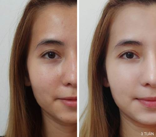 Trộn 3 thứ này với nhau, mụn tự hết vĩnh viễn, da tự trắng lên rõ rệt