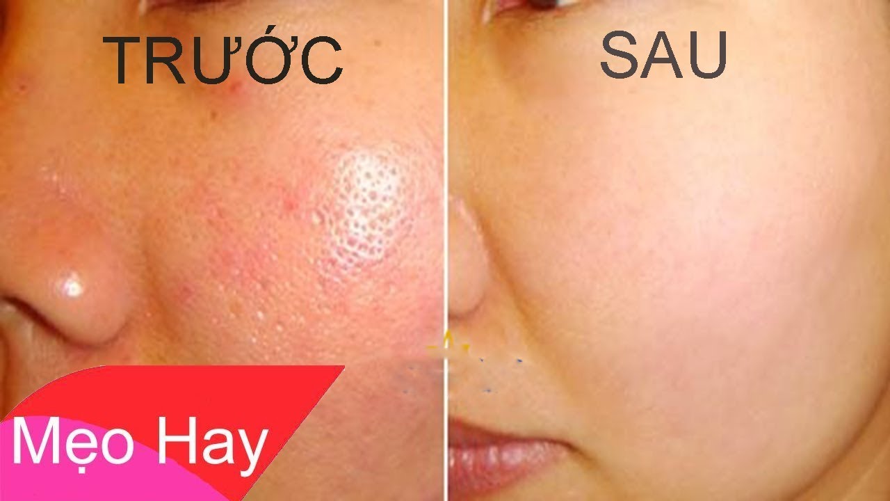 Se lỗ chân lông to đến đâu cũng se khít, da trắng bóc sau một đêm không sợ chồng bỏ nhờ loại mặt nạ này!