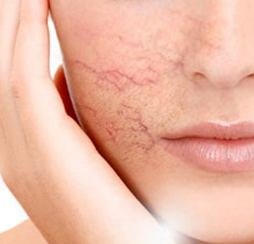 6 Bước làm dày da mặt mỏng hiệu quả 100&permil;