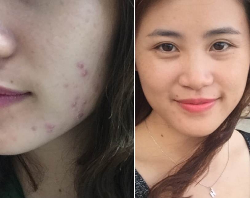 Top 5 cách trị vết thâm, se khít lỗ chân lông hiệu quả cho mọi loại da lấy lại làn da trắng sáng, mịn màng