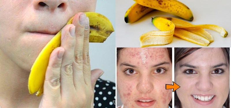 Đánh bay lũ mụn đáng ghét SIÊU NHANH – SIÊU HIỆU QUẢ từ vỏ của những loại quả mà chúng ta vẫn vứt đi hàng ngày