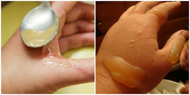 Bỏng kiểu gì cũng không lo sợ, cứ bôi thứ này lên 5 phút sau là hết đau rát, khỏi lo phồng rộp, sẹo thâm luôn nhé