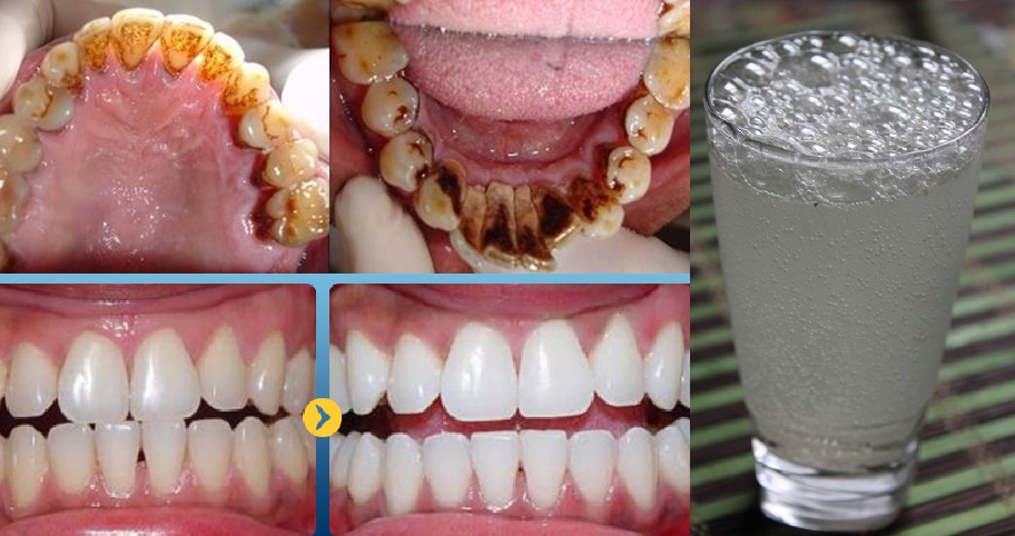 Ngậm ngụm nước này tầm 3 phút buổi tối là hơi thở sẽ thơm tho, răng trắng sáng, đều như hạt bắp ngay sáng ngày hôm sau
