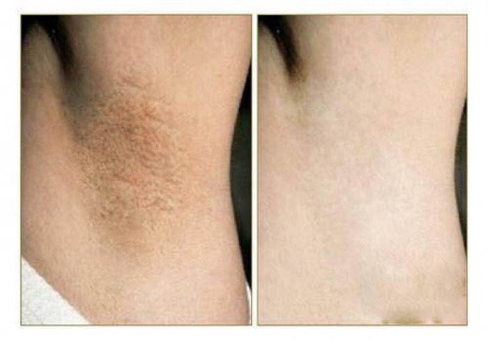 1 quả chanh + 2 cây cần tây: Nách, đầu gối, mông hết thâm, trắng mịn sau 1 tuần