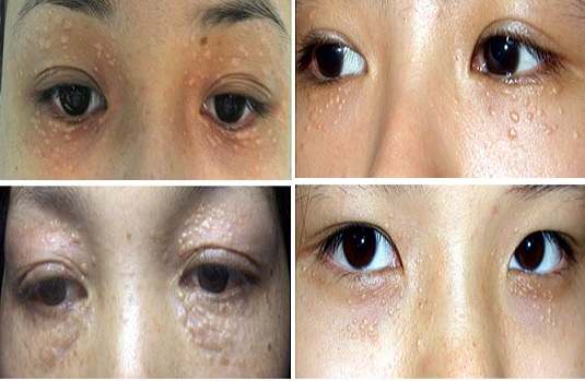 TOP 10 cách trị mụn thịt NHANH CHÓNG, HIỆU QUẢ và AN TOÀN NHẤT dành cho chị em đang tự ti vì mụn thịt trên mặt