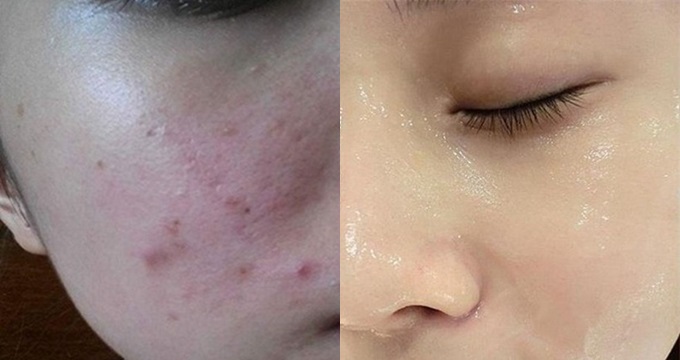 5 Công thức siêu đơn giản cứ làm là da trắng bóc, sạch mụn và hết thâm chỉ với 1 quả chuối