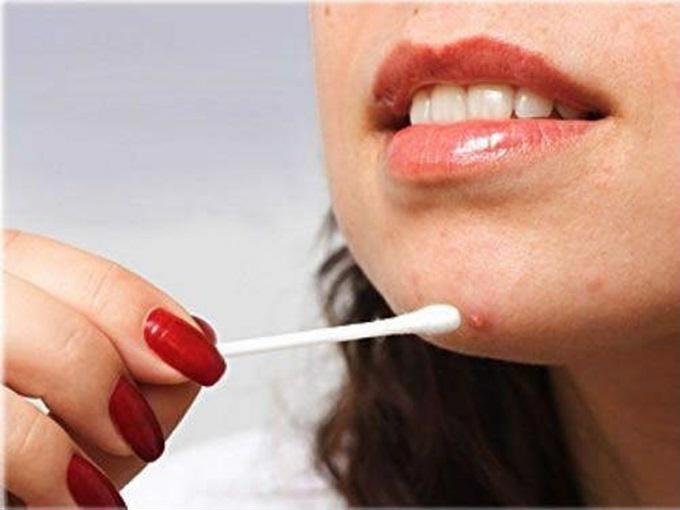 Mụn và sẹo thâm nở như hoa, chi chít khắp mặt cũng sạch sành sanh, trắng mịn một cách bất ngờ với công thức này