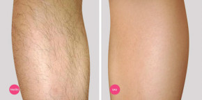 “Diệt trừ” vi – ô – lông VĨNH VIỄN - HIỆU QUẢ - KHÔNG MỌC LẠI với 3 cách tẩy lông tại nhà đơn giản