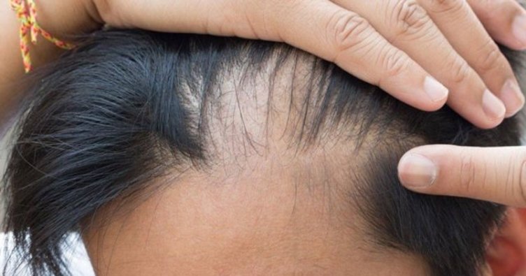 Bỏ ngay 5 thói quen tai hại này nếu không bạn sẽ bị rụng tóc và hói đầu