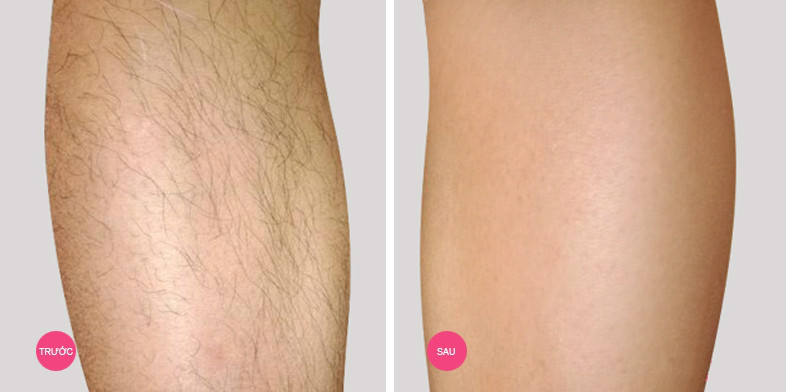 “Diệt trừ” vi – ô – lông VĨNH VIỄN - HIỆU QUẢ - KHÔNG MỌC LẠI với 3 cách tẩy lông tại nhà đơn giản