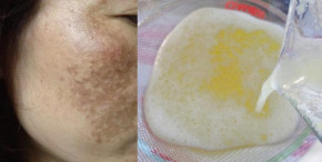 Triệu triệu phụ nữ đã dùng 2 thứ này mỗi ngày để trị &rsquo;vĩnh viễn&rsquo; nám và tàn nhang trên da