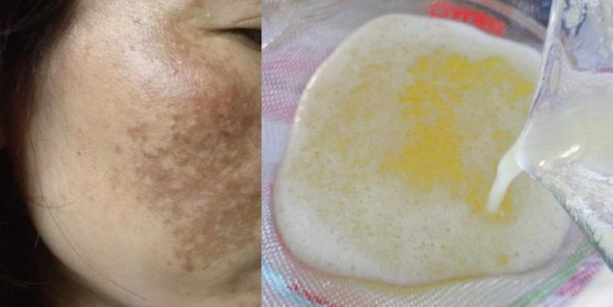 Triệu triệu phụ nữ đã dùng 2 thứ này mỗi ngày để trị &rsquo;vĩnh viễn&rsquo; nám và tàn nhang trên da