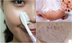 Top 6 cách lột mụn đầu đen tại nhà nhanh nhất, hiệu quả 100‰ mà không tốn quá 5K