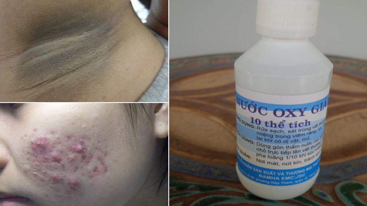 Hội con gái rỉ tai nhau  công thức làm đẹp “thần thánh” từ oxy già - Tiết kiệm cả “TẤN” tiền