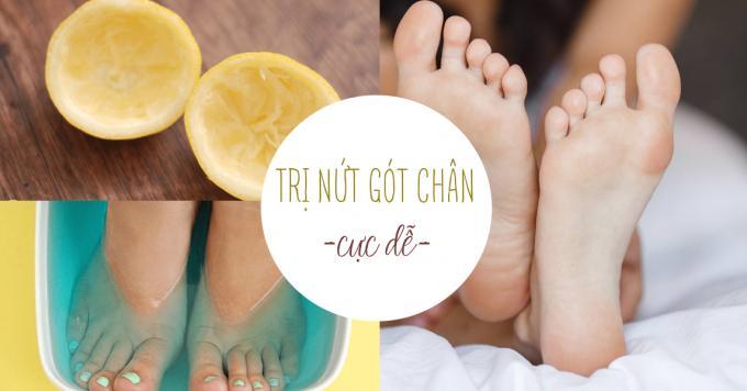 Gót chân khô ráp, nứt nở cũng mềm mịn chỉ sau vài đêm nhờ thực hiện CÔNG THỨC ĐẶC BIỆT này