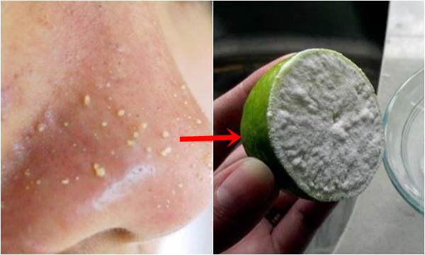 Cắt quả chanh làm đôi chấm vào đĩa muối rồi chà lên mũi, chà đến đâu mụn đầu sẽ tự chui ra đến đó