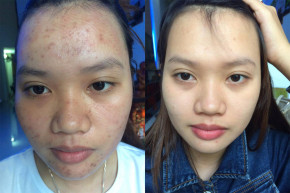 "Cấp cứu" làn da SƯNG THÂM, TẤY ĐỎ sau khi nặn mụn cực NHANH, cực HỮU HIỆU