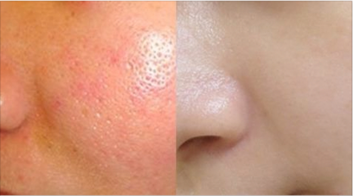 THU NHỎ LỖ CHÂN LÔNG 100&permil; NHỜ 1 HŨ SỮA CHUA 6k