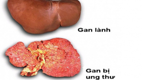 Mới hơn 30 tuổi bị ung thư gan, nguyên nhân gây bệnh hóa ra chính là người vợ của anh