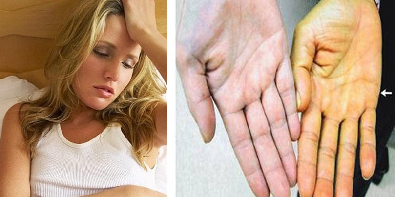 Các dấu hiệu cảnh báo sớm bệnh ung thư gan