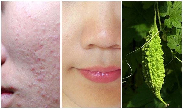 Hướng dẫn chi tiết các bước TRỊ MỤN ẨN giúp “đẩy” nhân mụn dưới da, trị mụn dứt điểm từ bên trong