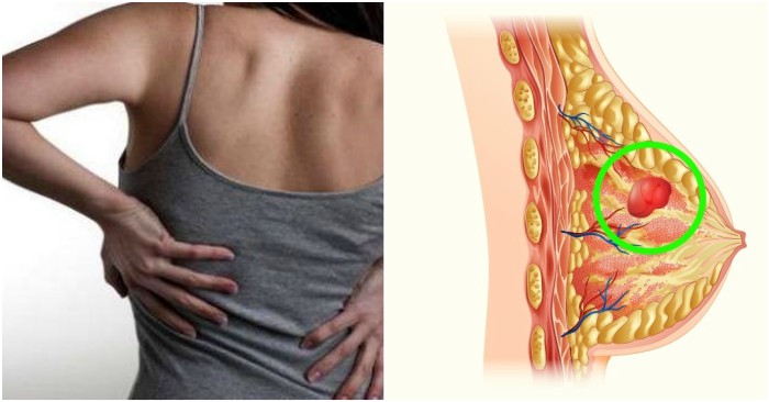 4 tác hại nghiêm trọng khi bạn mặc áo ngực 24/24