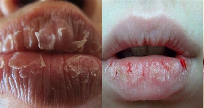 “Gậy ông đập lưng ông” - Tá hỏa vì dùng son dưỡng mãi vẫn khô môi