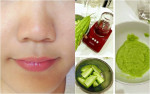 Sạch sành sanh mụn ẩn trong 2 tuần với tuyệt chiêu từ vài lát mướp đắng