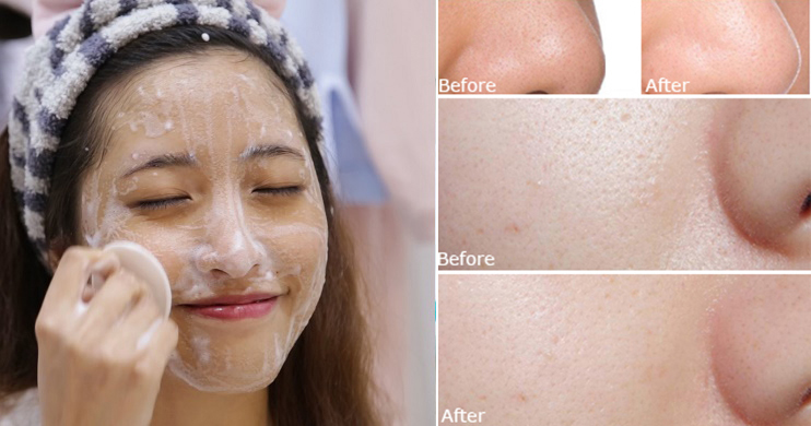 7 cách tự làm sạch sâu và chữa tắc lỗ chân lông cho da mặt mãi sáng mịn