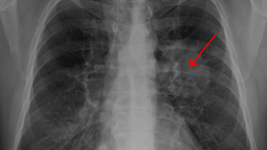 8 dấu hiệu cảnh báo UNG THƯ PHỔI đang sống trong cơ thể, nên biết sớm kẻo hối hận