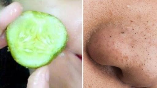 Cồi mụn đầu đen trồi lên ầm ầm chỉ với 1 lát dưa chuột chấm đường vừa rẻ vừa tiện có sẵn trong nhà bếp